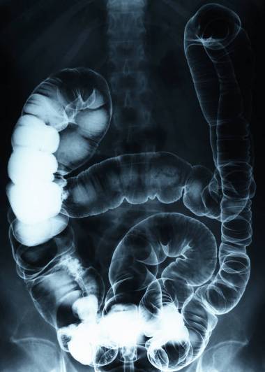 Cancer of the colon, rectum or bowel