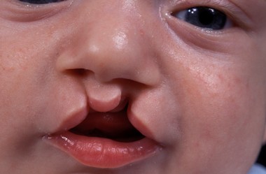 Cleft lip and palate