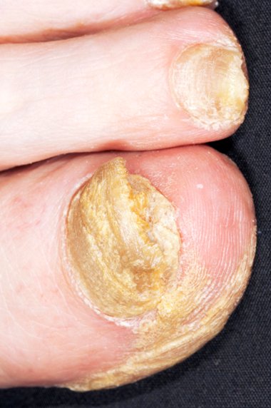 Finger Nail Infectionclose Shot Mans Finger Stock Photo 1350848843 |  Shutterstock