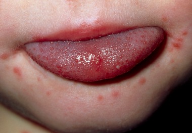 Hand, foot and mouth disease