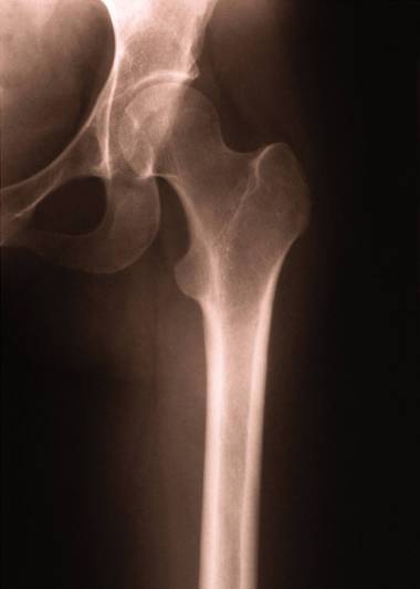 Hip fracture 