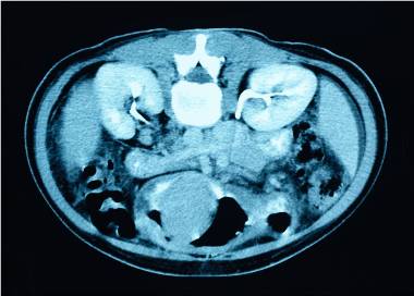 Kidney Disease, Autosomal recessive polycystic