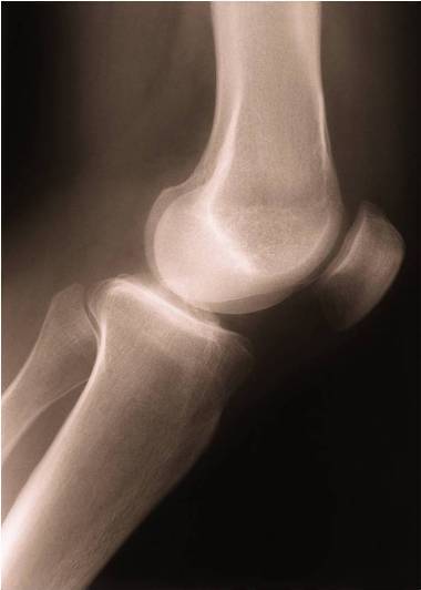 Knee surgery, anterior cruciate ligament