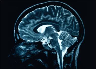 Brain MRI: What It Is, Purpose, Procedure & Results