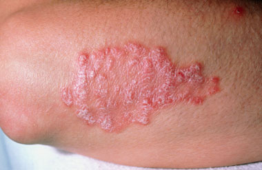 NHS 111 Wales - Health A-Z : Psoriasis
