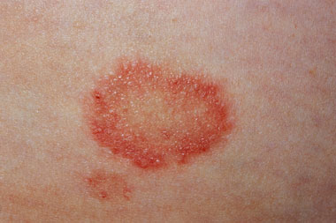 how do you stop the itching from ringworm