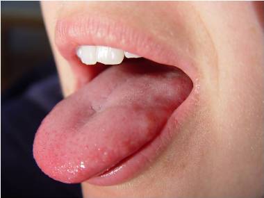 White bubble on tip of tongue