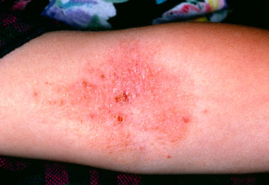 eczema in pregnancy nhs