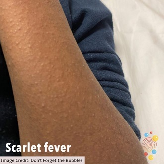 Scarlet Fever, What is Scarlet Fever?